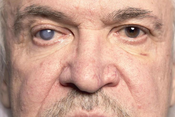 glaucoma, i primi sintomi da non sottovalutare l’elenco che devi conoscere